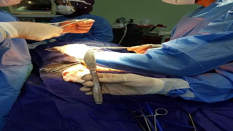 فريق طبي من الديوانية ينجح باستخراج “سكين” من بطن فتاة ابتلعته منذ 3 اشهر